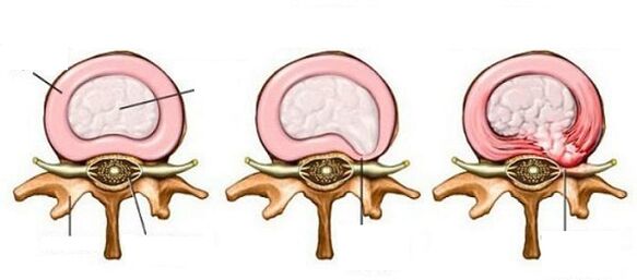 ernia intervertebrale con osteocondosi cervicale